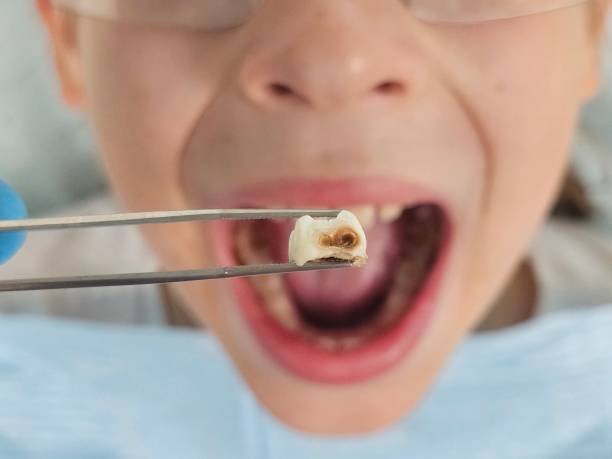Best Emergency Dental Care for Broken or Chipped Teeth in Henagar, AL